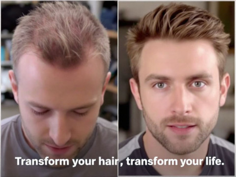 حبوب توقف تساقط الشعر