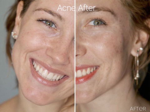 اثار حب الشباب